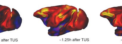 Healing neurological disorders with ultrasound