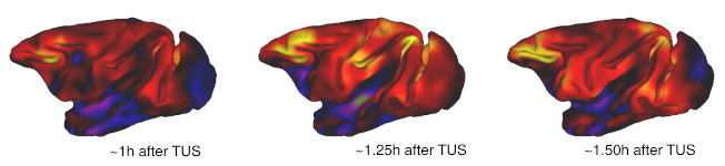 Healing neurological disorders with ultrasound