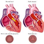 Non-invasive therapy of aortic stenosis: a successful first clinical trial
