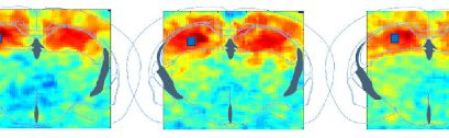 Pharmaco-fUS: How Ultrasound could foster drug discovery in neuroscience