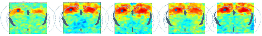 Pharmaco-fUS: How Ultrasound could foster drug discovery in neuroscience