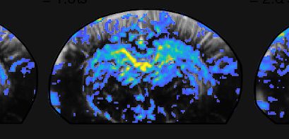 How does the brain activity change during repetitive behaviours?