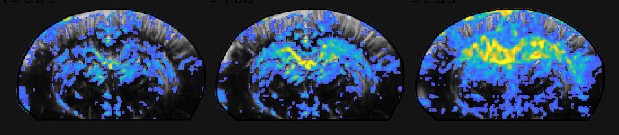 How does the brain activity change during repetitive behaviours?