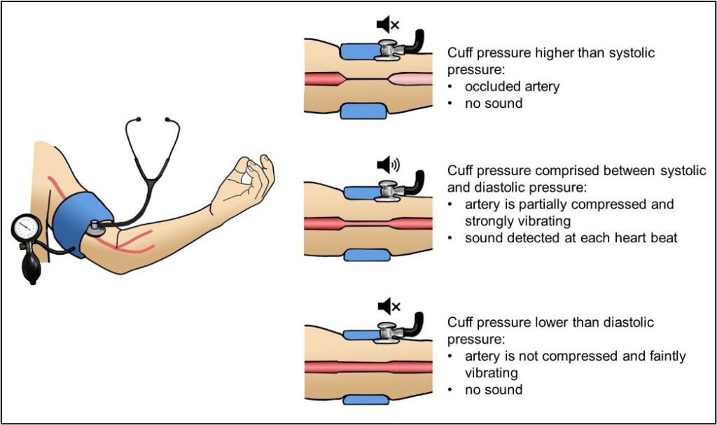 Korotkoff sounds a centuryold enigma of physics is finally solved