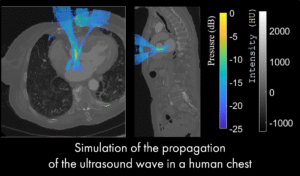 Our study in collaboration between Cardiawave and researchers from Physics for Medicine Paris presents a 3D numerical model of ultrasonic propagation through the ribcage, designed for applications in non-invasive cardiac ultrasound therapy.