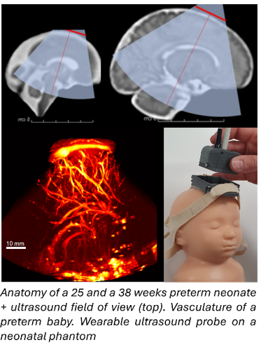Research Internship : Realistic vascular and structural neonatal head phantom to improve the optimization of neonatal functional ultrasound probes Research Internship : Realistic vascular and structural neonatal head phantom to improve the optimization of neonatal functional ultrasound probes