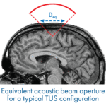 Toward global safety standards for transcranial ultrasound stimulation: new publication in Brain Stimulation