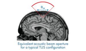 A new consensus paper co-authored by Jean-François Aubry and David Attali has been recently published in Brain Stimulation: “ITRUSST Consensus on Biophysical Safety for Transcranial Ultrasound Stimulation”