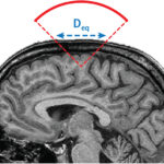 Toward global safety standards for transcranial ultrasound stimulation: new publication in Brain Stimulation