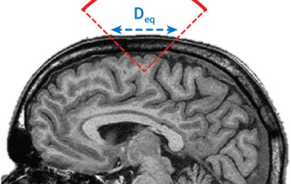 Toward global safety standards for transcranial ultrasound stimulation: new publication in Brain Stimulation