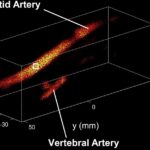 New Publication in Ultrasound in Medicine & Biology: 4D Wide-Field Ultrafast Ultrasound of the Human Carotid Using a Multi-Lens Probe