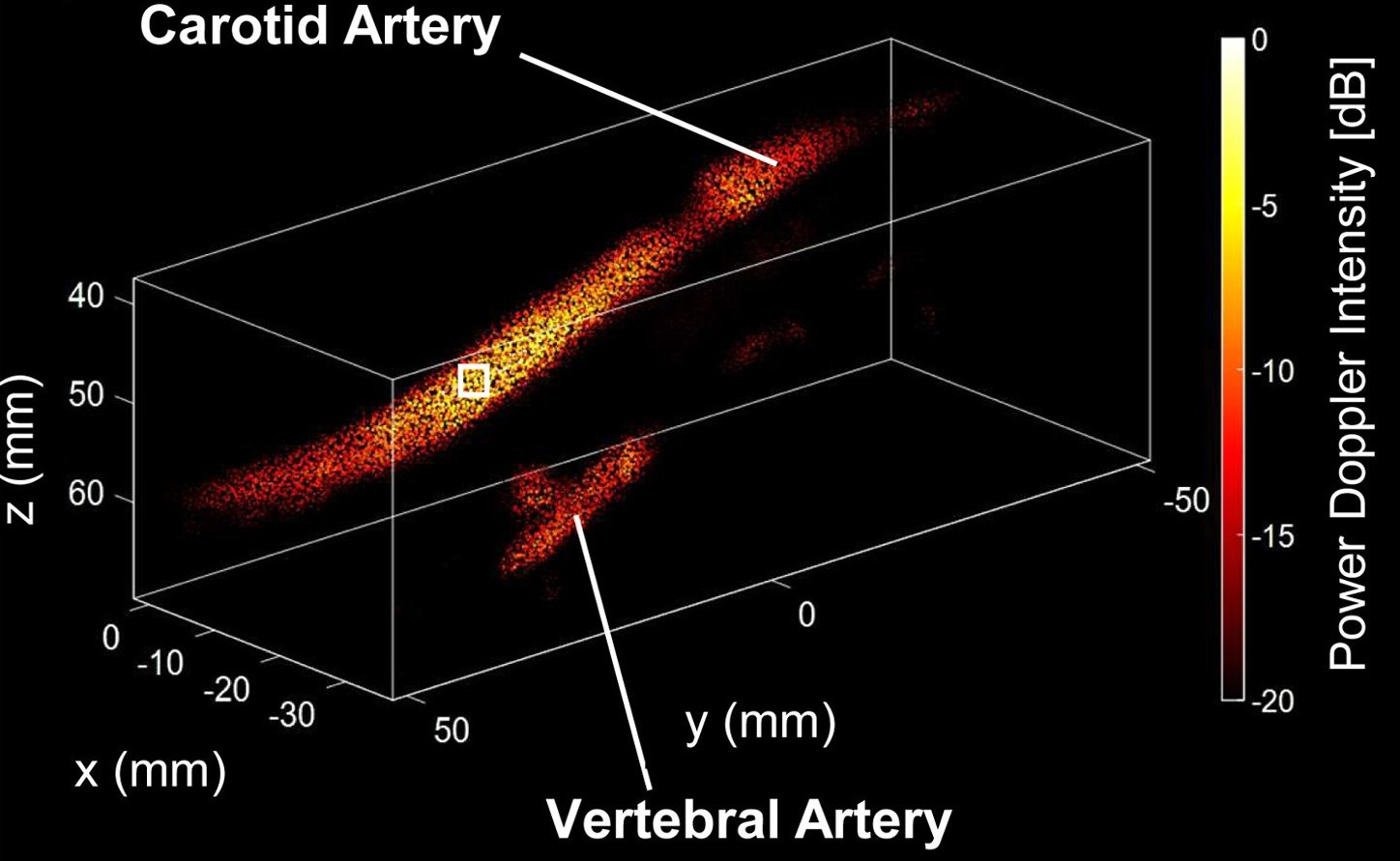New Publication in Ultrasound in Medicine & Biology: 4D Wide-Field Ultrafast Ultrasound of the Human Carotid Using a Multi-Lens Probe