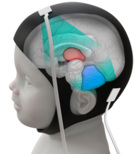 Design of optimal wearable ultrasound probe for neonatal functional ultrasound imaging using an in silico realistic brain phantom and in vitro validation.